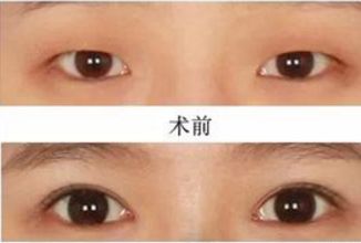 昆明哪家醫(yī)院做熱瑪吉好？挑選昆明熱瑪吉治療專業(yè)的醫(yī)院指南