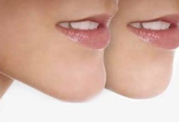 河南唇腭裂休復(fù)哪家好？專業(yè)醫(yī)院推薦及成功案例分享