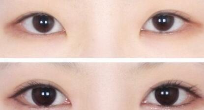 2023永州拉皮手術改善嘴角下垂排行榜前10名的醫(yī)生(楊鵬、宋海濤、何琦蕾閉眼選擇不踩雷~)