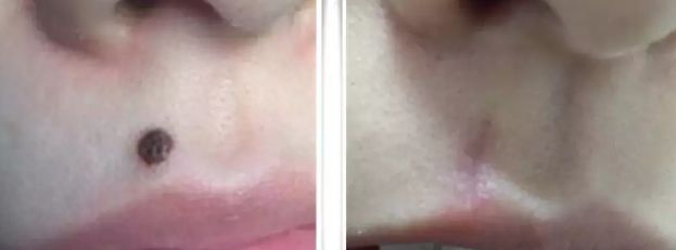 福州割眼袋醫(yī)院排行榜2023：哪家醫(yī)院割眼袋好？