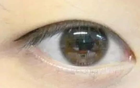 揭曉2023年武漢哪家醫(yī)院割雙眼皮好，專家推薦及真實案例！