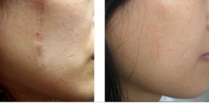 南京開雙眼皮哪家醫(yī)院好？幫你解析南京哪家醫(yī)院做開雙眼皮效果最好