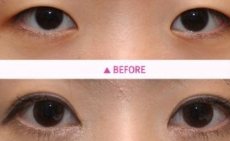 洛陽哪家雙眼皮醫(yī)院專業(yè)又靠譜？