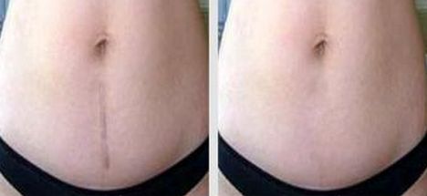 聊城激光祛痘醫(yī)院哪家好？選擇聊城最適合你的激光祛痘醫(yī)院