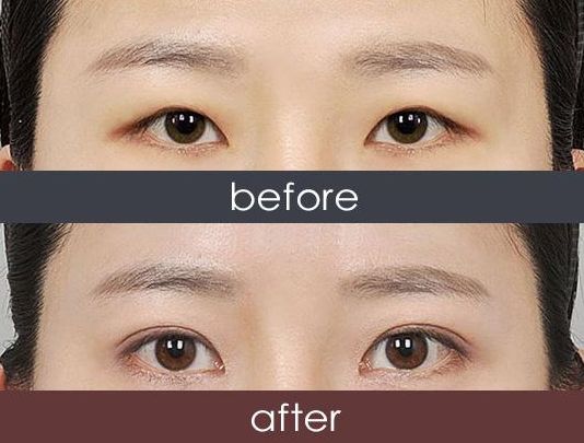 福州哪家醫(yī)院激光祛雀斑效果好？