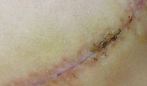 太原疤痕醫(yī)院排名哪家好？解密太原疤痕治療領域中的第一名