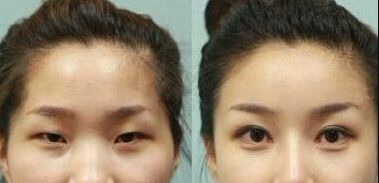 深圳隆鼻手術效果如何？哪家醫(yī)院的鼻綜合技術較好？