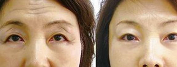 2023廣州超聲法去眼袋手術(shù)口碑榜前10強(qiáng)的醫(yī)生(湯敏、吳智南、謝洪新這些專家口碑絕了，推薦收藏)