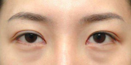 昆明做雙眼皮手術(shù)好的醫(yī)院有哪些？