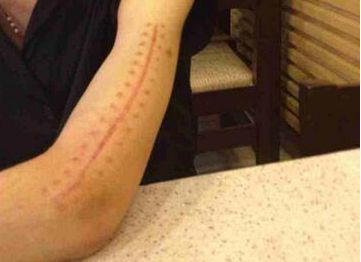 哈爾濱疤痕醫(yī)院哪家好？2023最新排名及患者口碑綜合分析