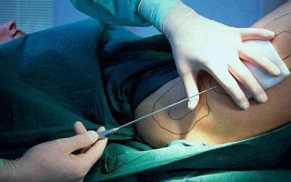 北京東方和諧整形專家馮斌：帶你了解吸脂整形的效果如何