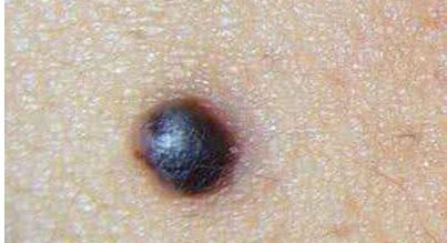 上海沈鶯鶯最新雙眼皮效果揭秘，價(jià)格公開！驚艷案例分享