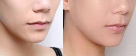 沈陽(yáng)朱石江顴骨整形手術(shù)具有良好效果？詳解醫(yī)生推薦報(bào)道！