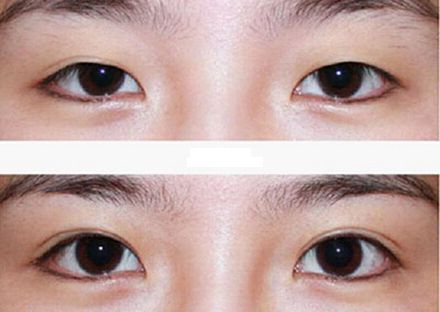 【2023年蘭州歪脖子手術(shù)哪家好？專家推薦+真實(shí)案例分析】