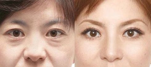 成都做乳暈漂紅哪家好？乳暈漂紅的價格、效果、方法哪種最合適？