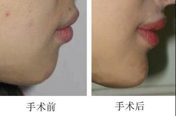 昆明哪家醫(yī)院做上臉下垂手術(shù)好，醫(yī)生技術(shù)靠譜？