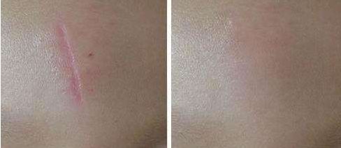 深圳哪家醫(yī)院脂肪豐胸效果好？