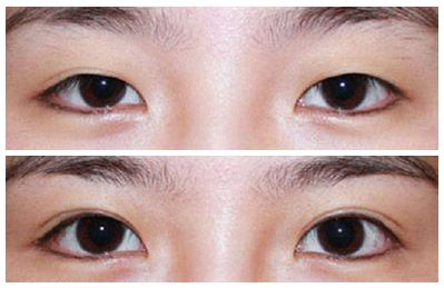 2023安徽韓式三點(diǎn)雙眼皮權(quán)威專家排名前十(劉愛國、王凱、朱飛口碑評價都很高)