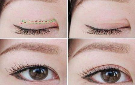 上海打臥蠶哪家醫(yī)院好？選擇上海治療臥蠶一流的醫(yī)院