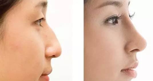 2023中山八大處做隆鼻排名榜前十名醫(yī)生(鐘宏宇、許琴、顏玲正規(guī)專家包你滿意)