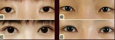 嘟嘟唇無錫哪家醫(yī)院好？專家推薦無錫哪家醫(yī)院治療嘟嘟唇好