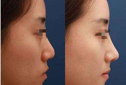 鄭大二附院：魏星vs劉月麗「誰更具魅力」雙眼皮對決揭曉！