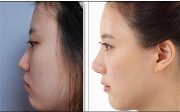 尹寧北唇裂的治療方法與修復(fù)手術(shù)現(xiàn)場(chǎng)展示！擁有自信笑容的秘訣！