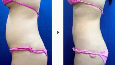 北京受歡迎的隆鼻醫(yī)生有哪些？揭秘5位經(jīng)驗豐富且備受好評的醫(yī)療專家