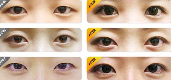 北京做雙眼皮哪家醫(yī)院好？排名最靠前的北京雙眼皮醫(yī)院有哪些？