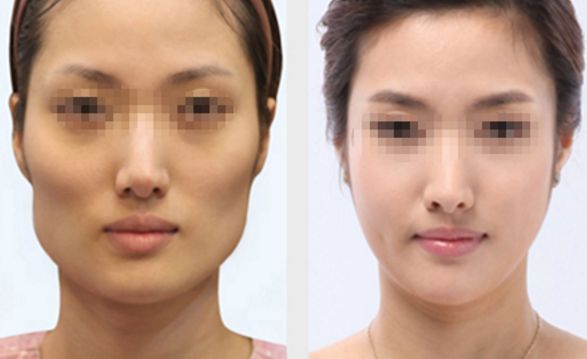 長(zhǎng)春雙眼皮修復(fù)好的醫(yī)院有哪些？