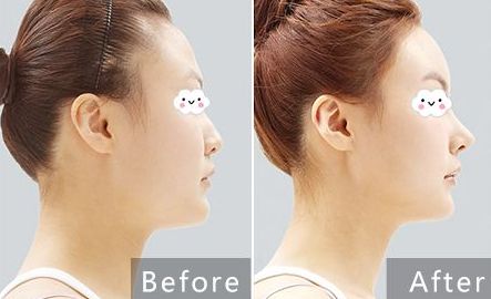 貴陽(yáng)治療痘坑哪家醫(yī)院專業(yè)可靠？