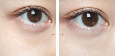 專家解讀杜園園眼袋修復術，醫(yī)生背景介紹、就診醫(yī)院信息及療效科普