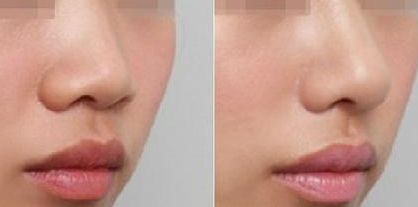 深圳修復雙眼皮哪家醫(yī)院好？淺談深圳雙眼皮修復專家排行榜