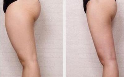 商丘做雙眼皮去哪家好？選擇最適合自己的雙眼皮整形醫(yī)院