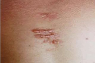 成都祛疤痕效果好的醫(yī)院有哪些？