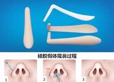 上海哪家醫(yī)院祛斑去痣好？專家?guī)懔私庾钸m合你的祛斑去痣方法！