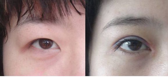 上海市激光修復(fù)痘坑效果如何？哪家醫(yī)院技術(shù)更好？