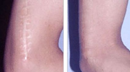 哈爾濱哪家醫(yī)院去除痘痘增生效果好，推薦給大家！