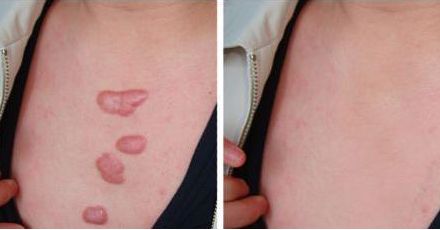 上海疤痕醫(yī)院去哪家好？專(zhuān)家推薦的上海疤痕治療醫(yī)院有哪些？