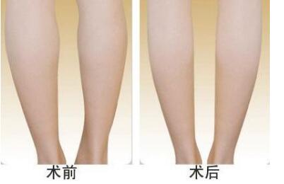 李闖隆鼻效果對比：神奇改變顏值，素顏自信重?zé)ㄇ啻海?></a></div>
                        <div>
                            <h4><a href=