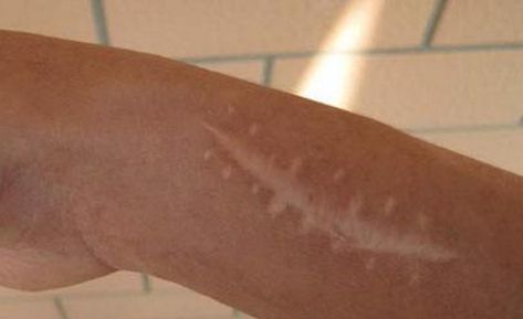 南京哪家醫(yī)院的疤痕修復(fù)效果最佳？