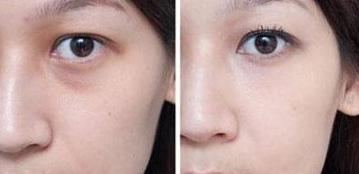 北京楊鍇做雙眼皮手術有哪些收費情況？手術案例一覽