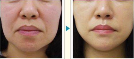 溫州激光祛痘醫(yī)院排行榜，哪家專業(yè)好評多