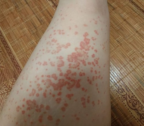 卿勇進行雙眼皮手術的評估和價格參考