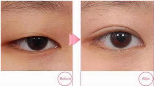 寧波哪家醫(yī)院做韓式雙眼皮效果好？