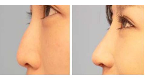 大連瑞和醫(yī)療美容醫(yī)院受歡迎嗎？楊檸澤做雙眼皮效果怎樣？真實網(wǎng)友體驗來了解！