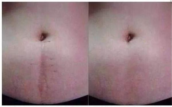 深圳哪家醫(yī)院專業(yè)治療傷疤效果好？