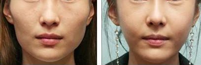 重慶雙眼皮整形醫(yī)院評(píng)價(jià)如何？哪家信譽(yù)好？