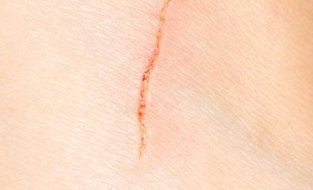 浙江開(kāi)眼角哪家醫(yī)院技術(shù)好？選擇哪家醫(yī)院效果最佳