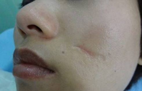 吉林市切開雙眼皮哪家好？一篇詳細的雙眼皮手術評測指南。